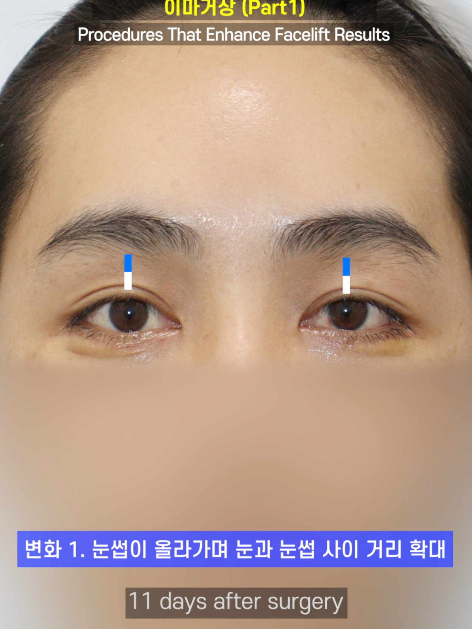 @다시피움성형외과 DASIPIUM タシピウム