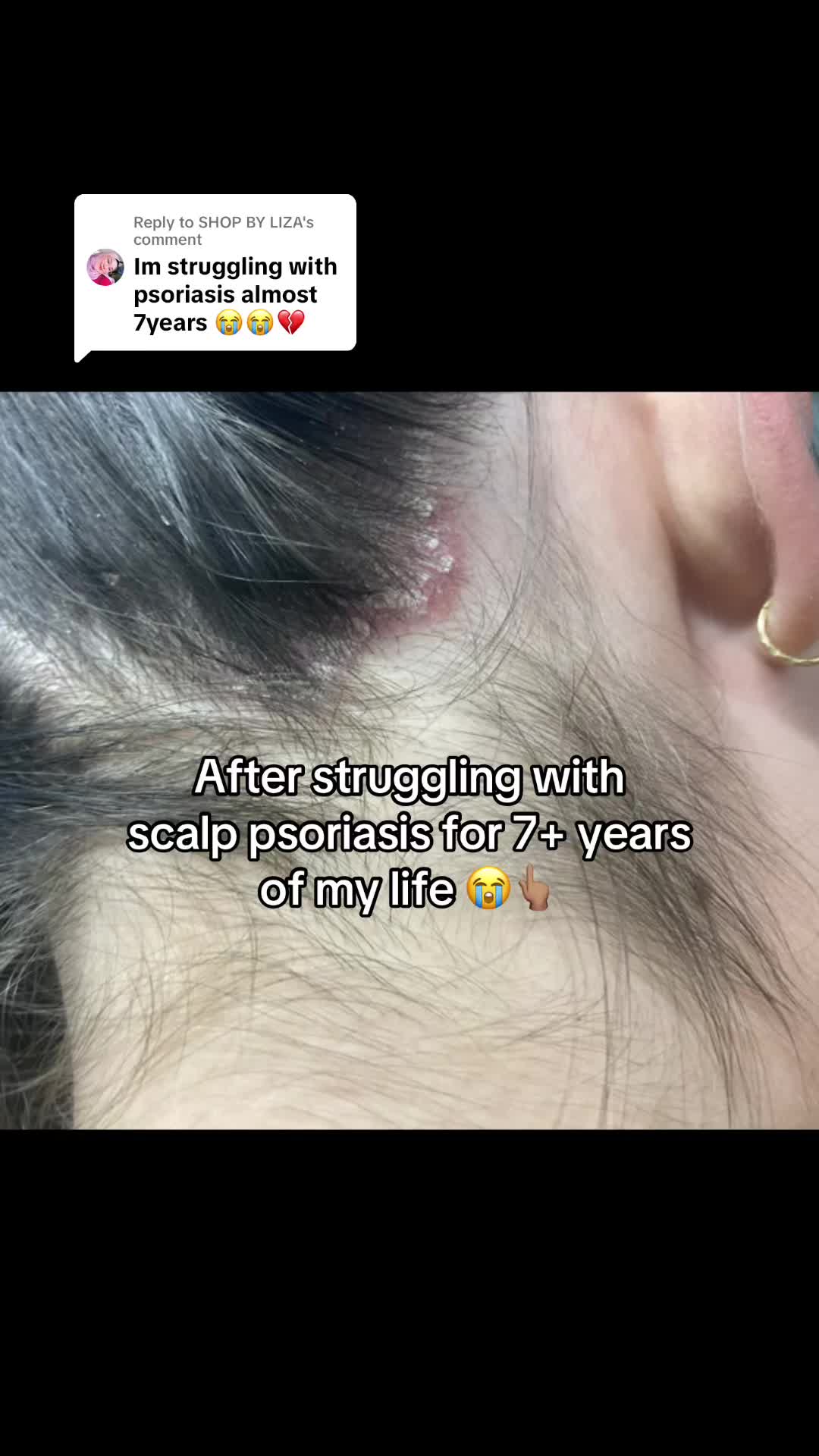 @Eczema Diaries USA & UK