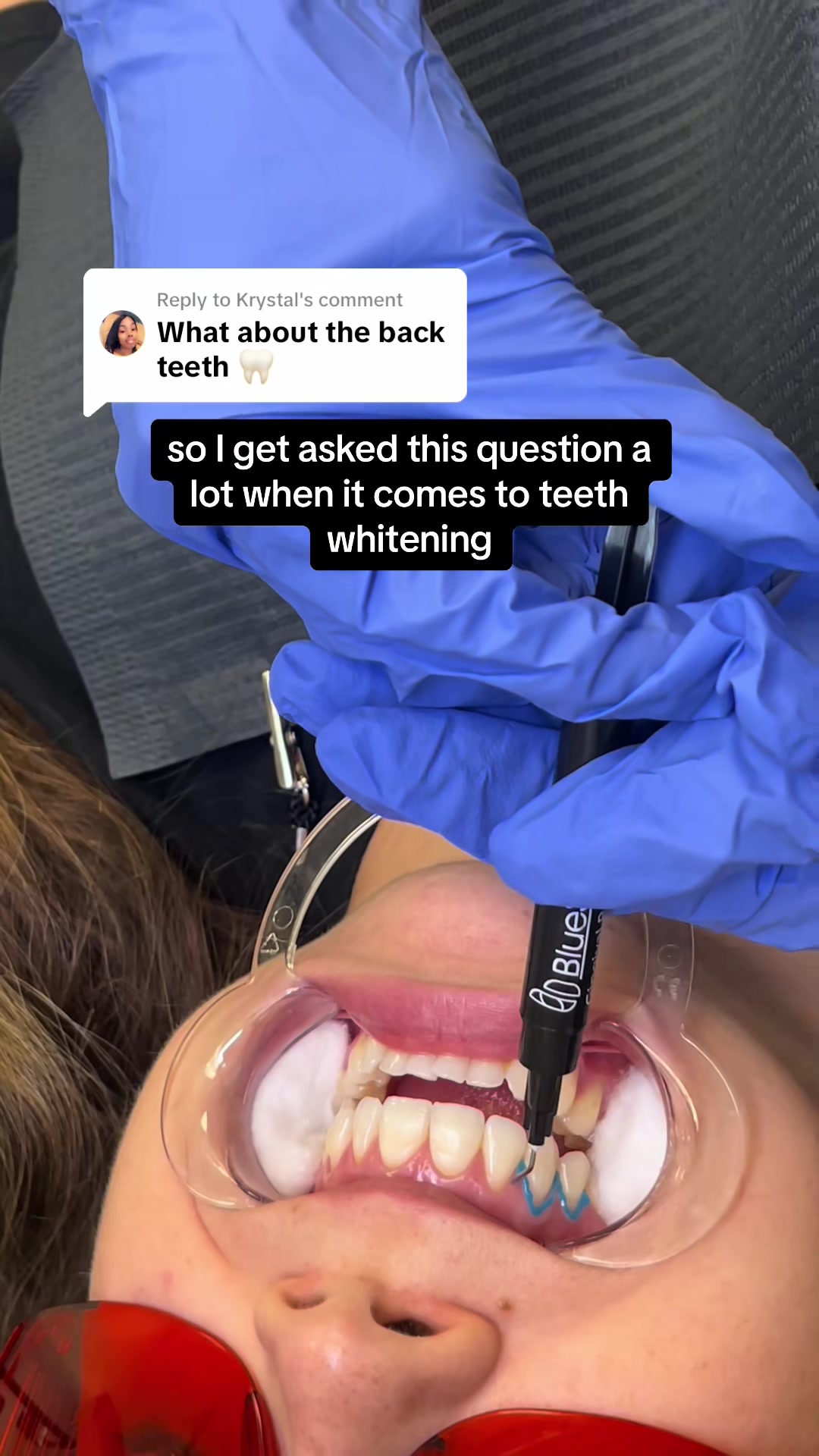 @Diandra | Teeth Whitening Tech