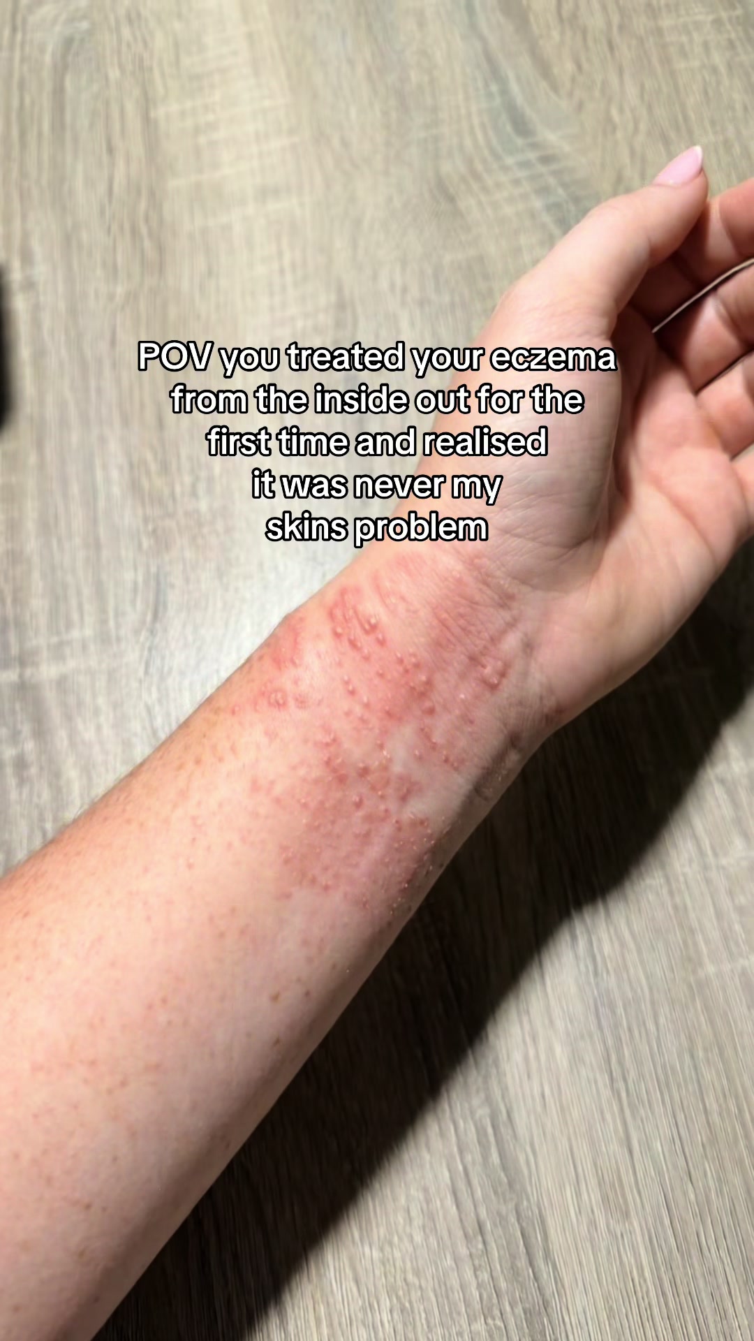@Eczema Diaries USA & UK