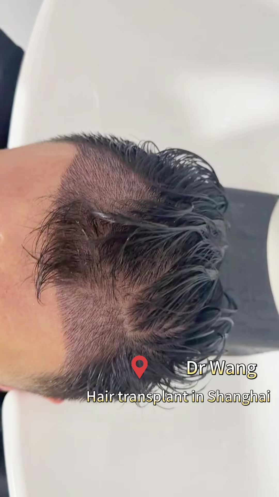 @HAIR TRANSPLANT WANG🇨🇳