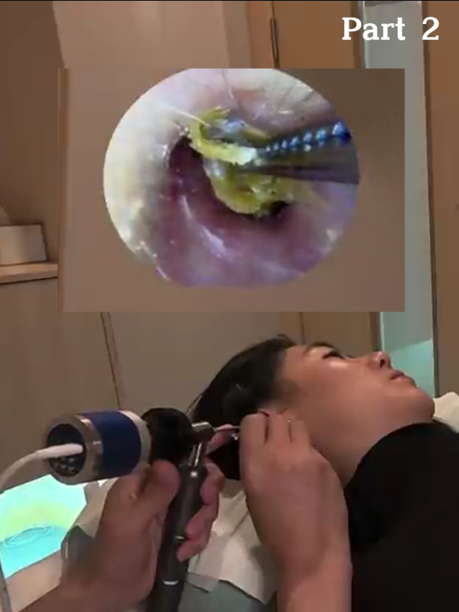 @ASMR Ear Cleaning