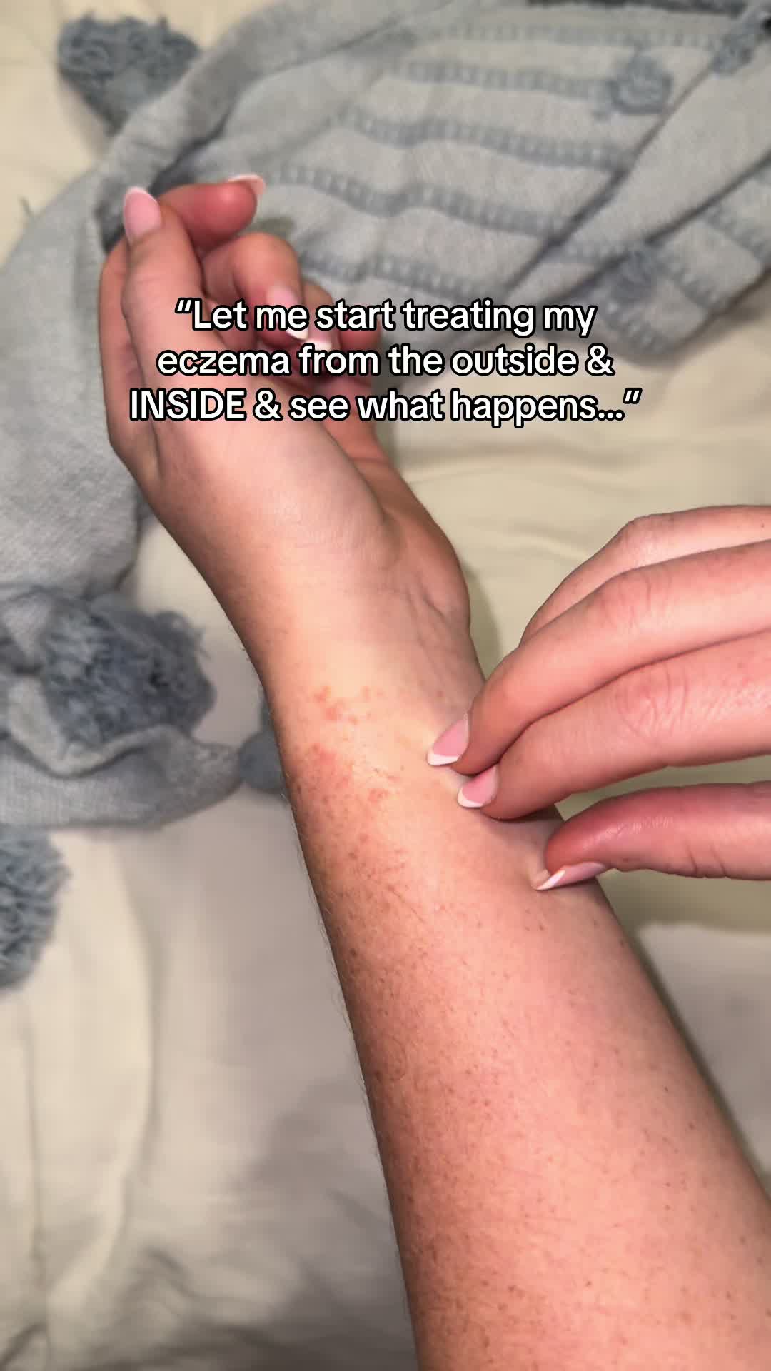 @Eczema Diaries USA & UK