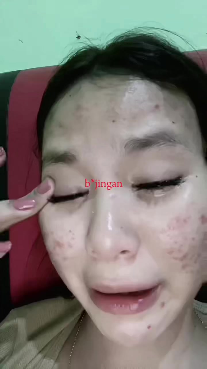 @Natha | Acne fighter
