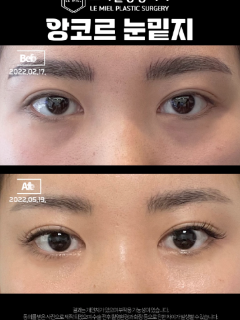 @르미엘성형외과