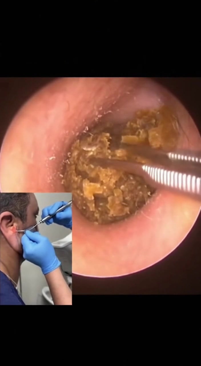 @Ear Cleaning
