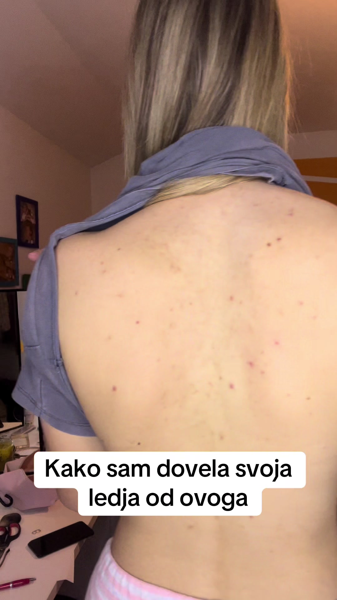 @obrisii.flekice