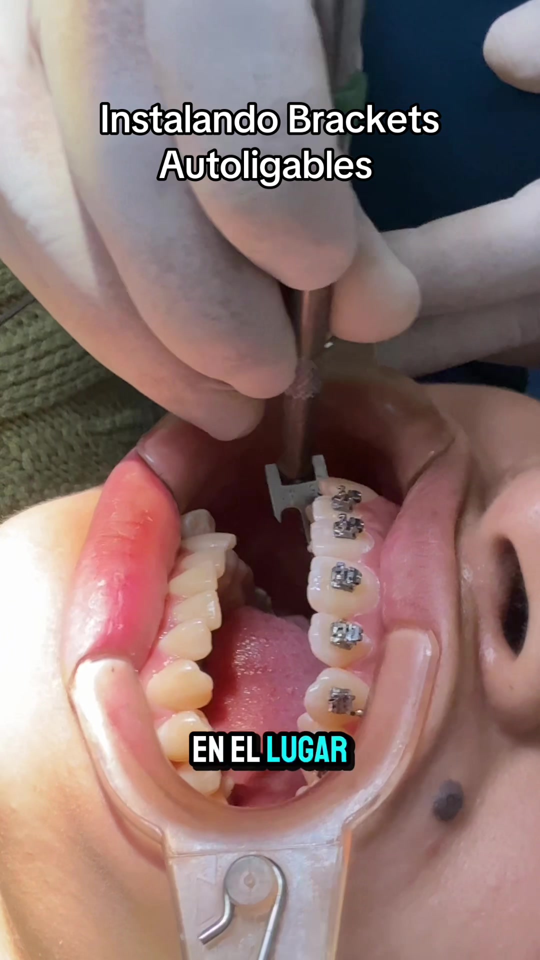 @DentikaBrackets
