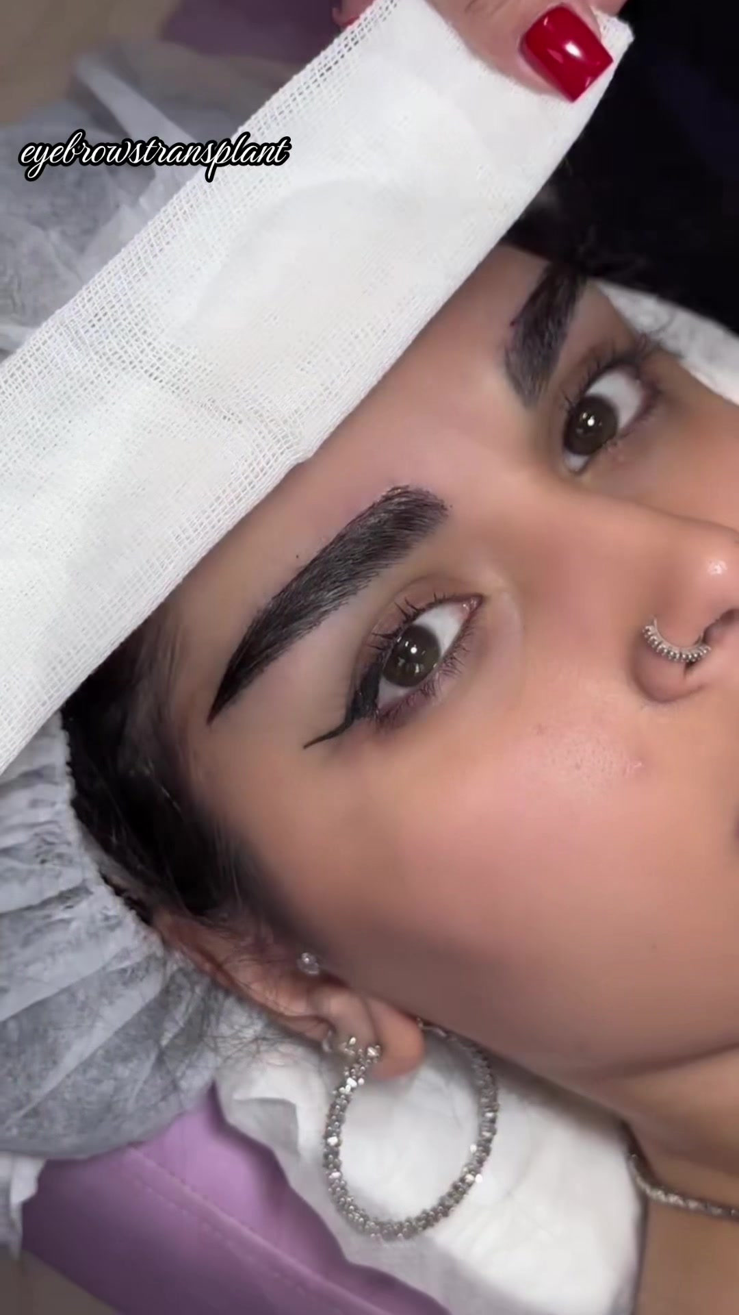 @Eyebrows Transplant
