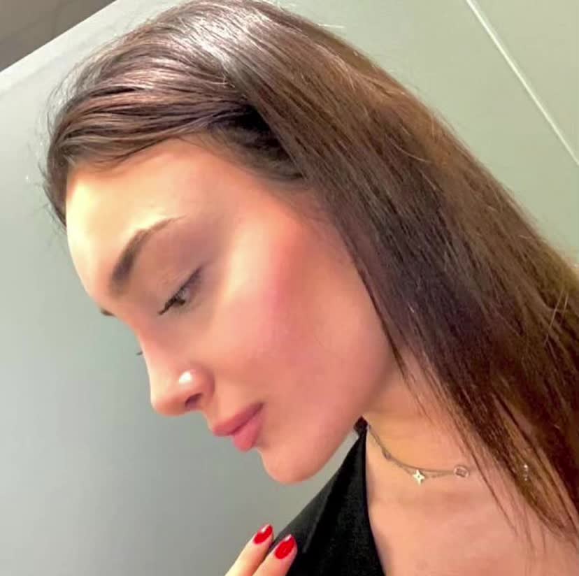 @Lor Cərrah Rinoplastika🌸✅