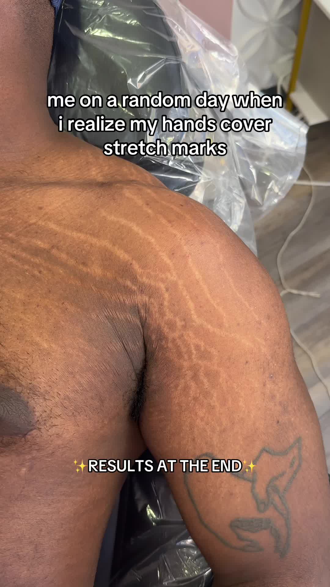 @Stretch Mark Fairy 🧚✨