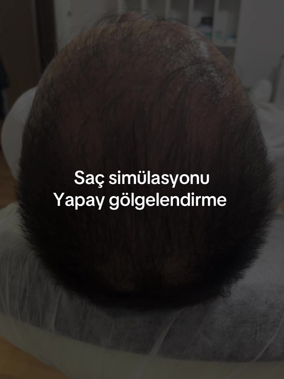 @Güven Kartal hair Clinic