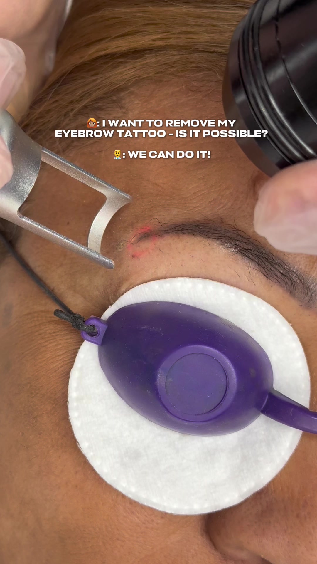 @Safe Eyebrows Tattoo Removal🗽