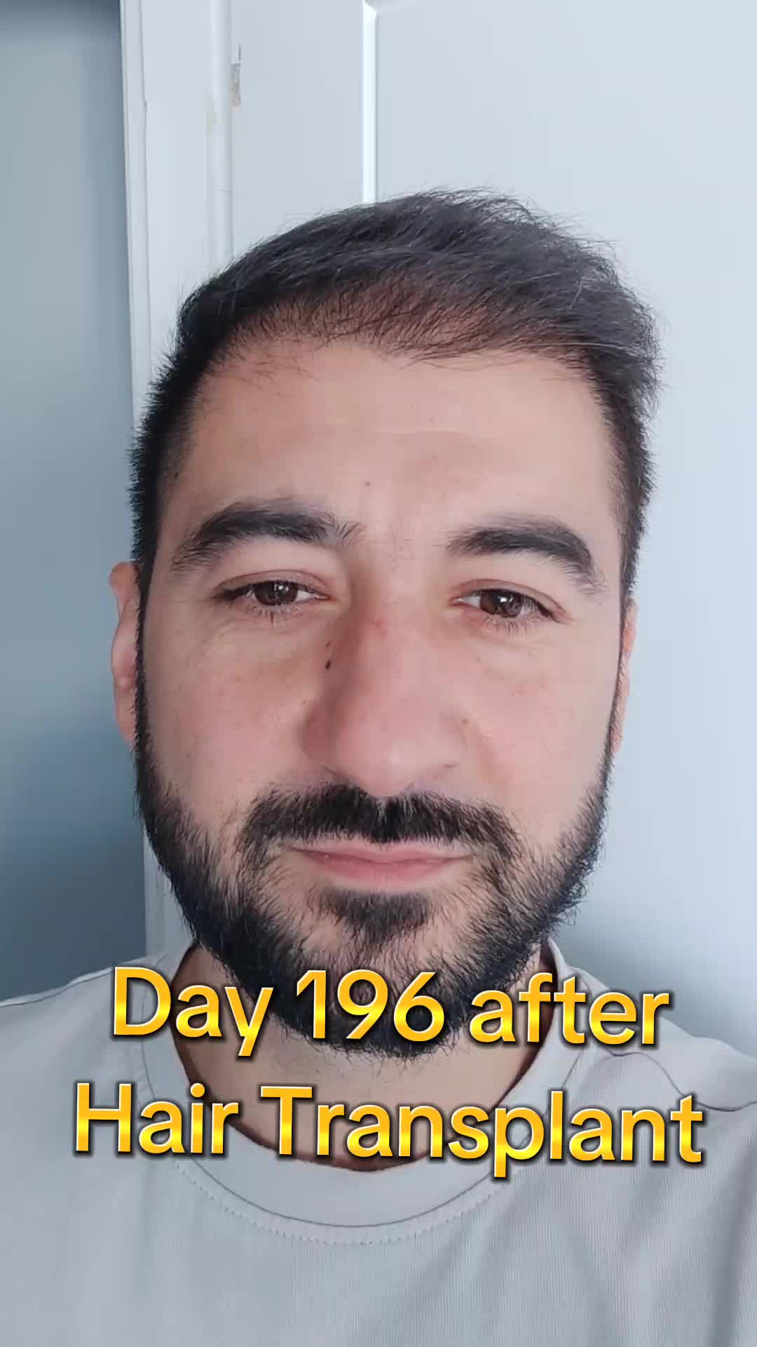 @My hair transplant
