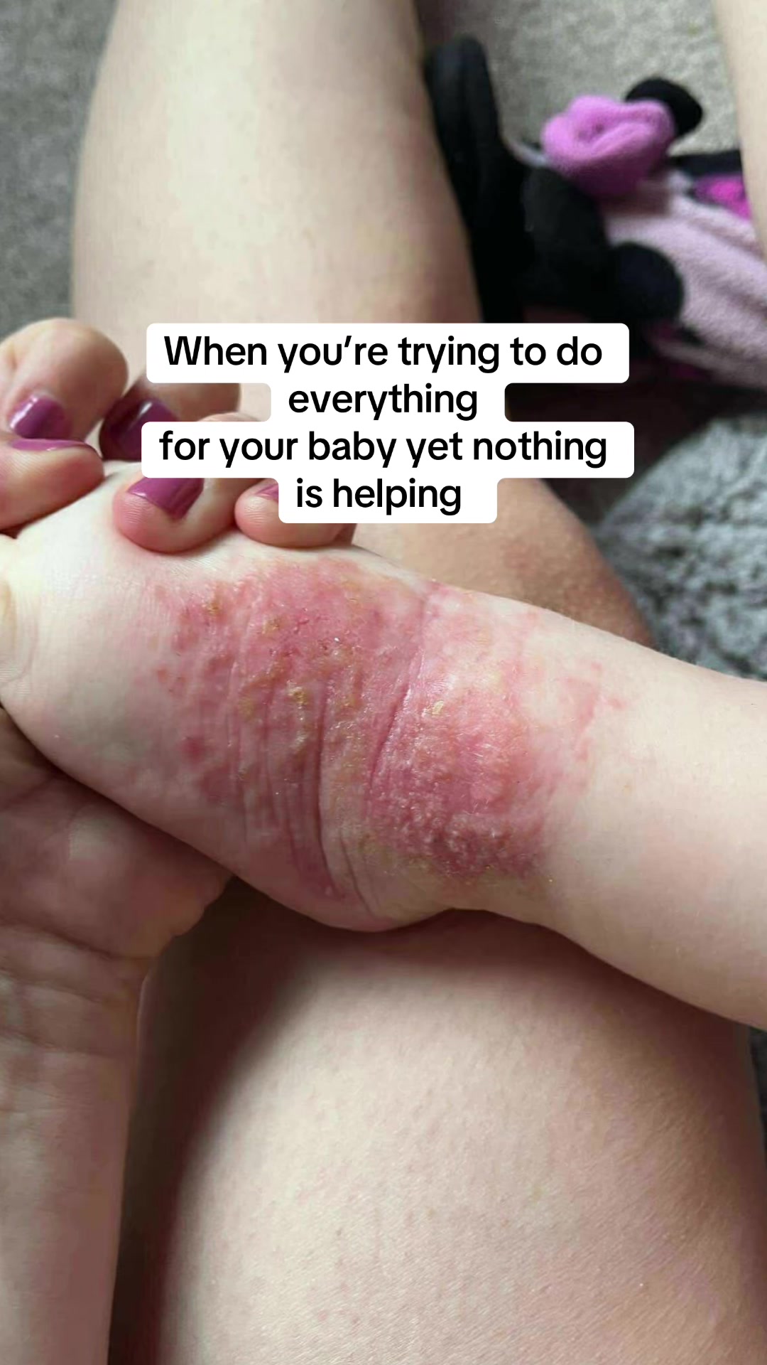 @Eczema Diaries USA & UK
