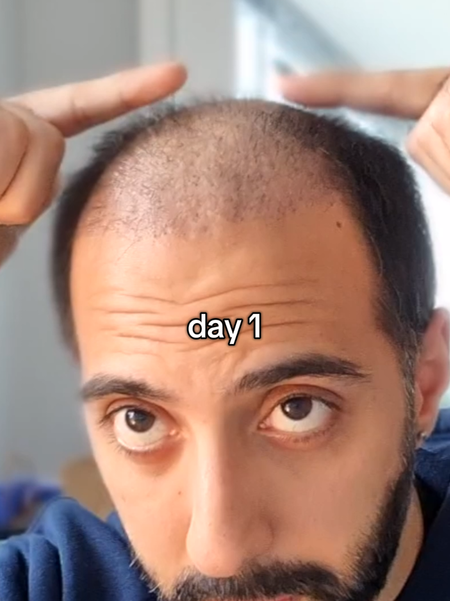 @Amit | Hair Transplant Tips