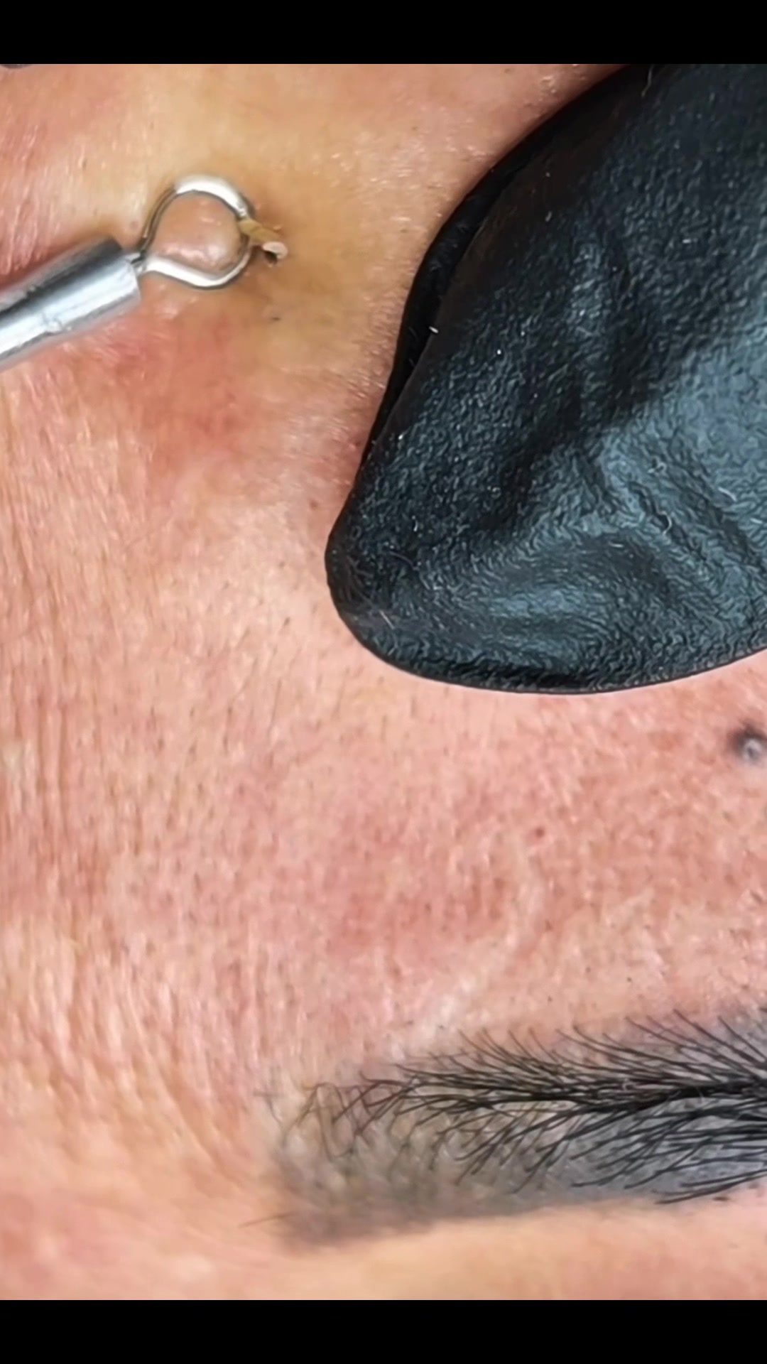 @pimplepopperasmr