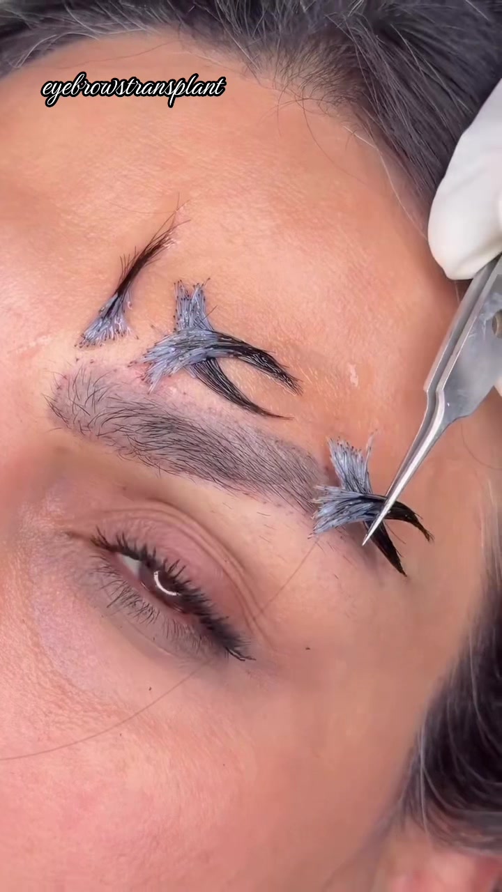 @Eyebrows Transplant