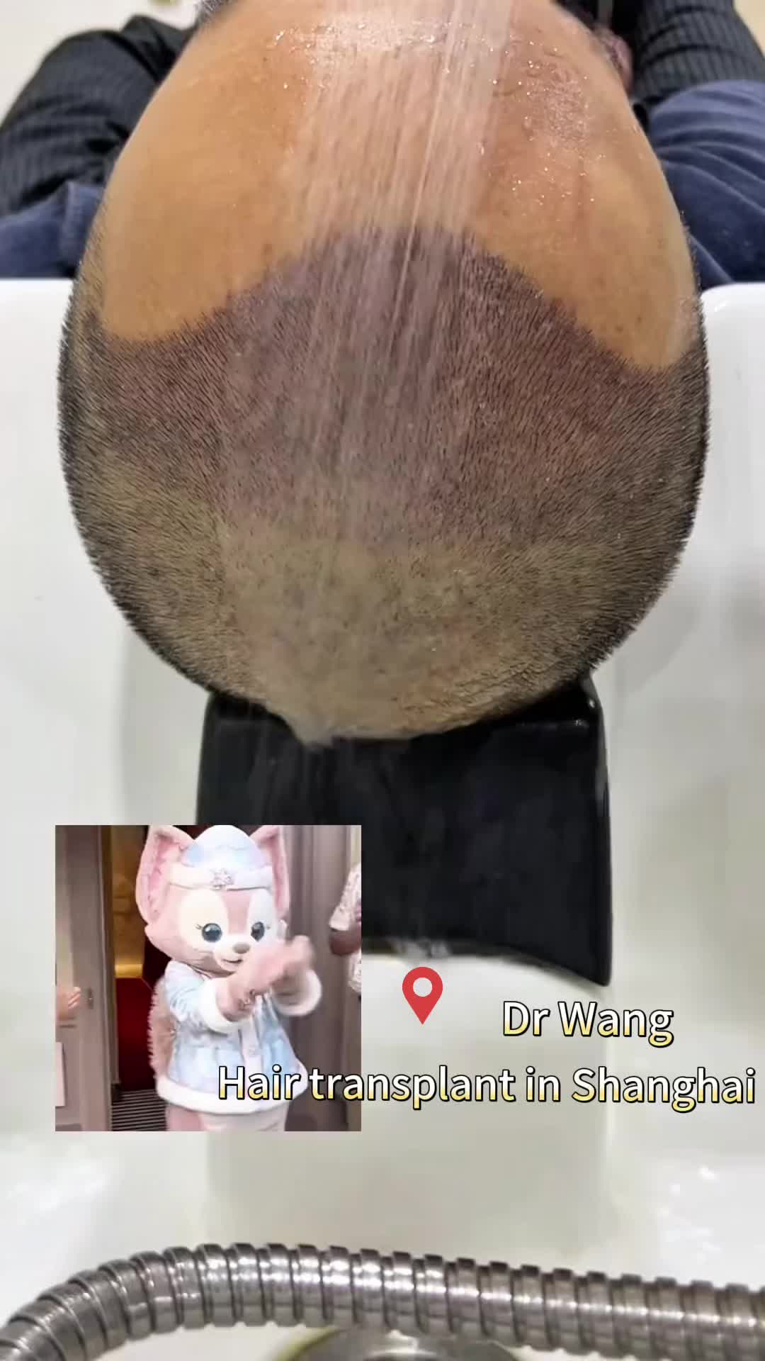 @HAIR TRANSPLANT WANG🇨🇳