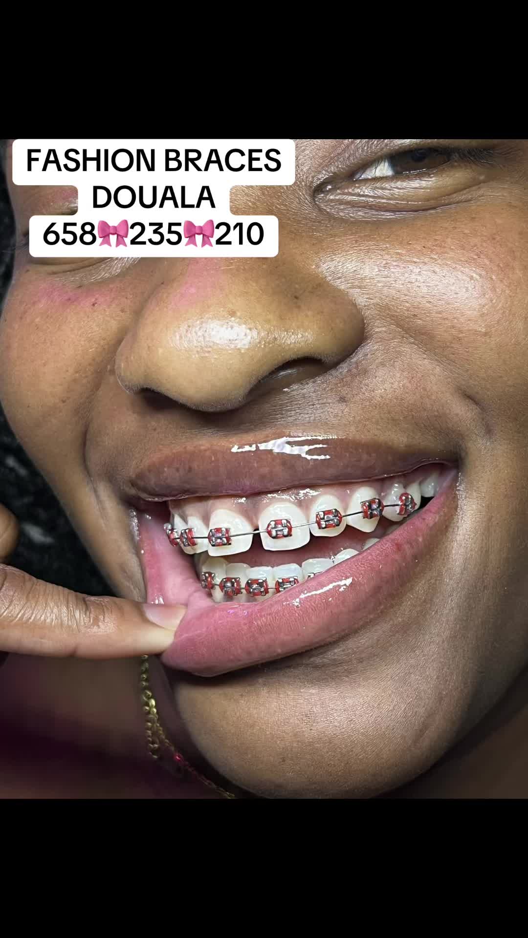 @MG BRACES