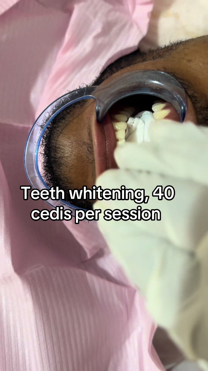 @Teethwhitening—MartGlow Avenue