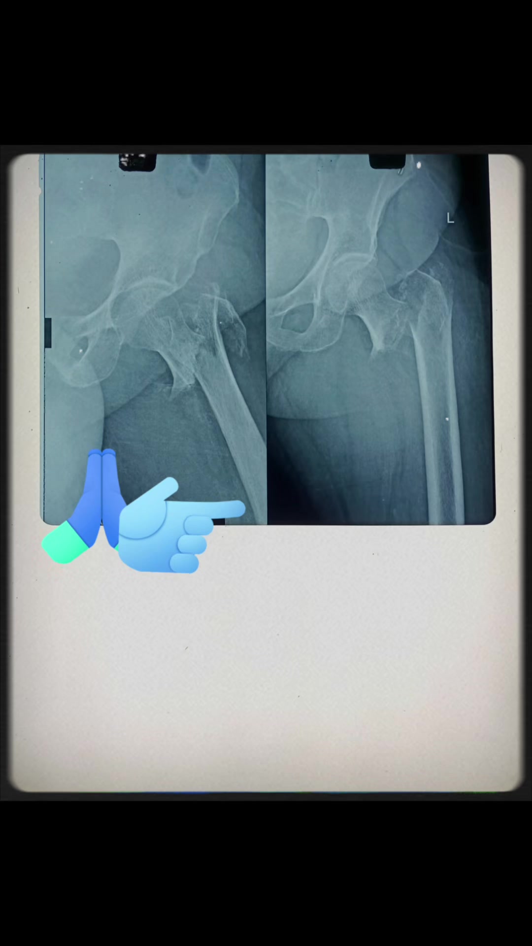 @Orthopedic_Surgeon_Arbind
