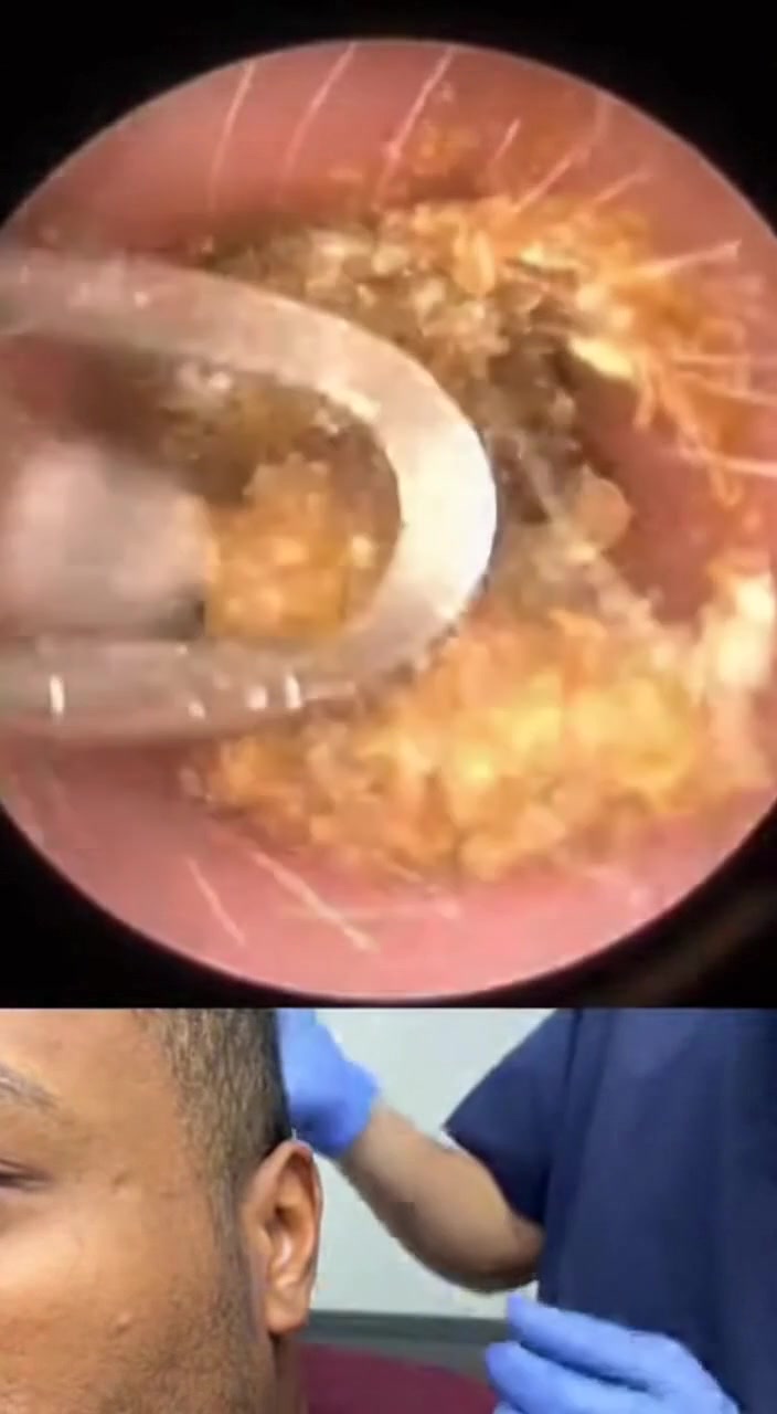 @Ear Cleaning