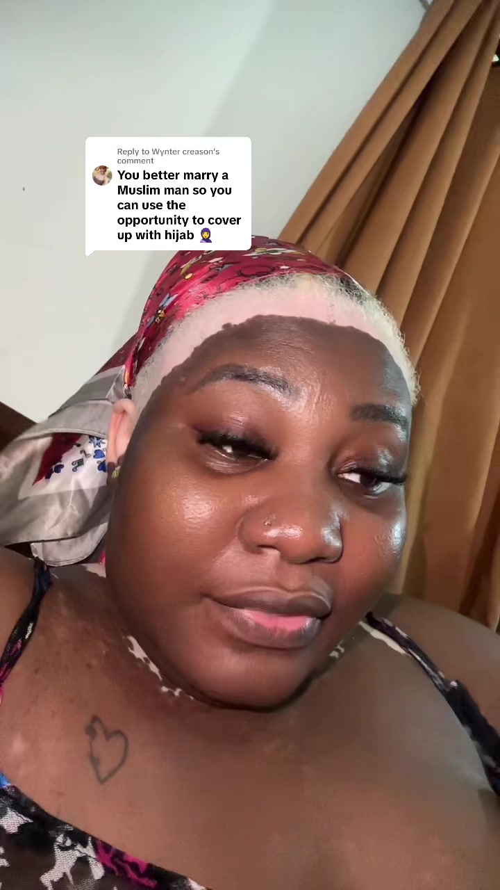 @Thevitiligogirl