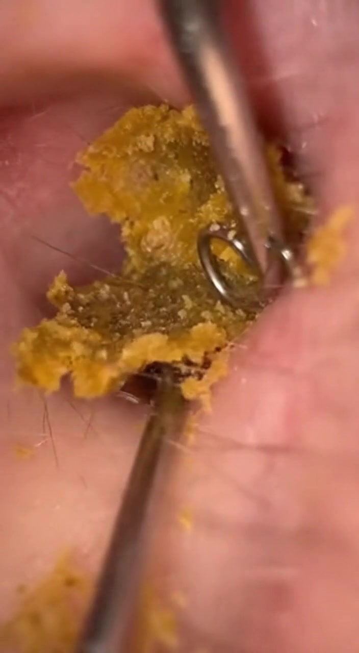 @Ear Cleaning