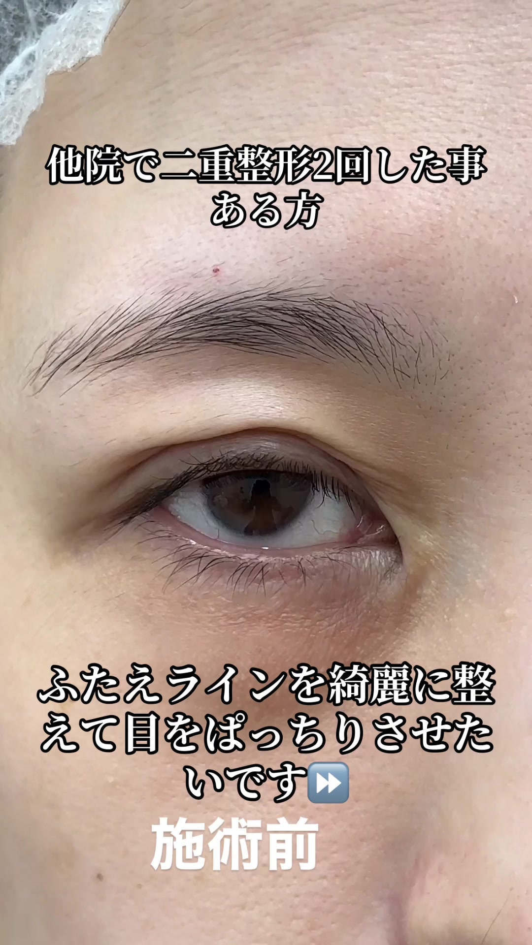 @二重整形埋没法/広島美容外科メイプルクリニック院長 吉本如良