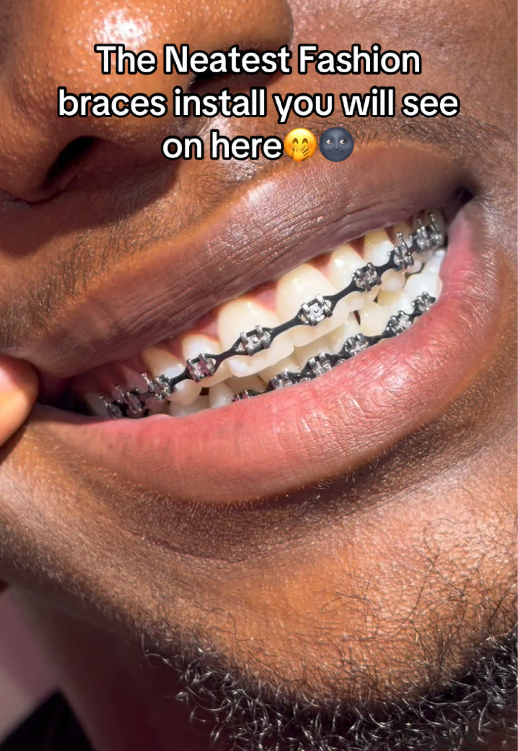 @Abuja Fashion Braces/Toothgems