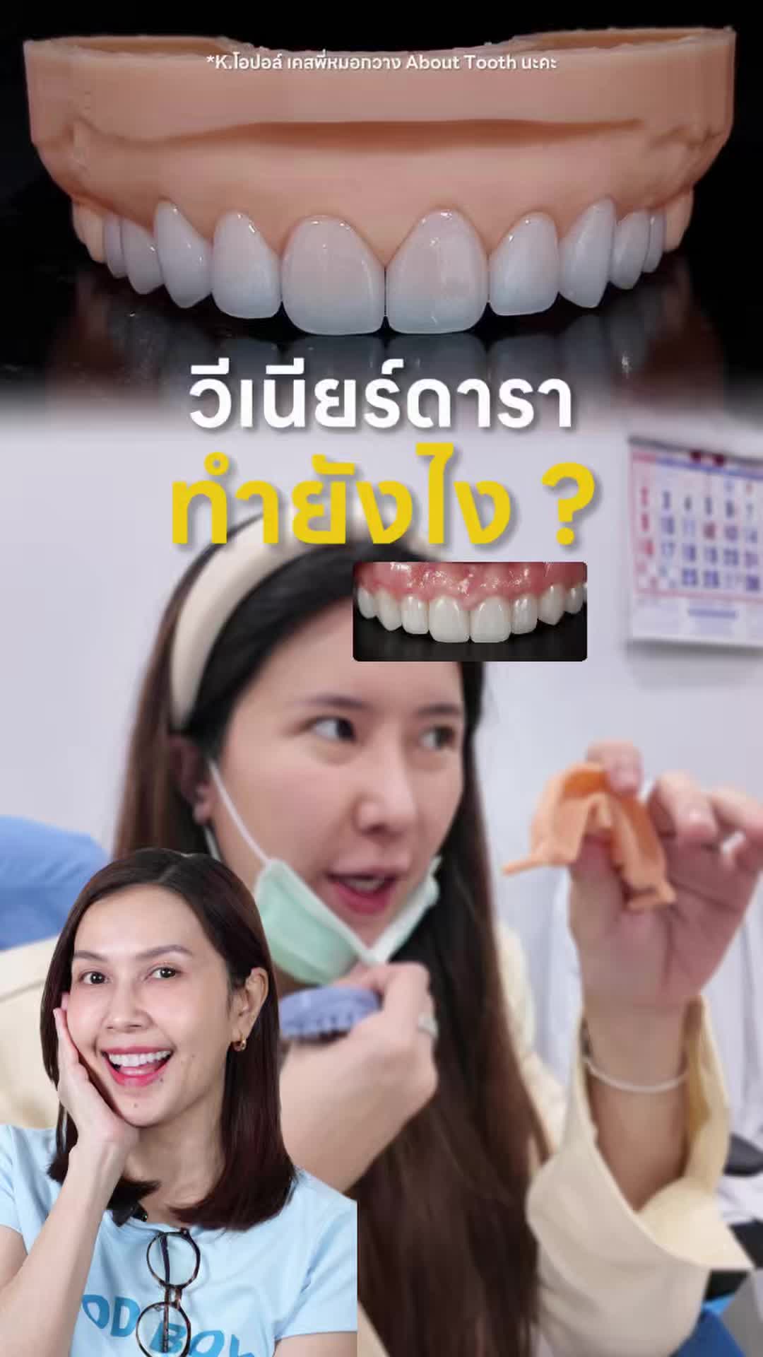 @หมอป่องสวยมาก veneer 🦷