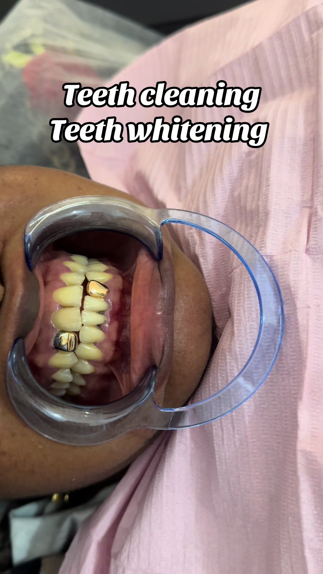 @Teethwhitening—MartGlow Avenue