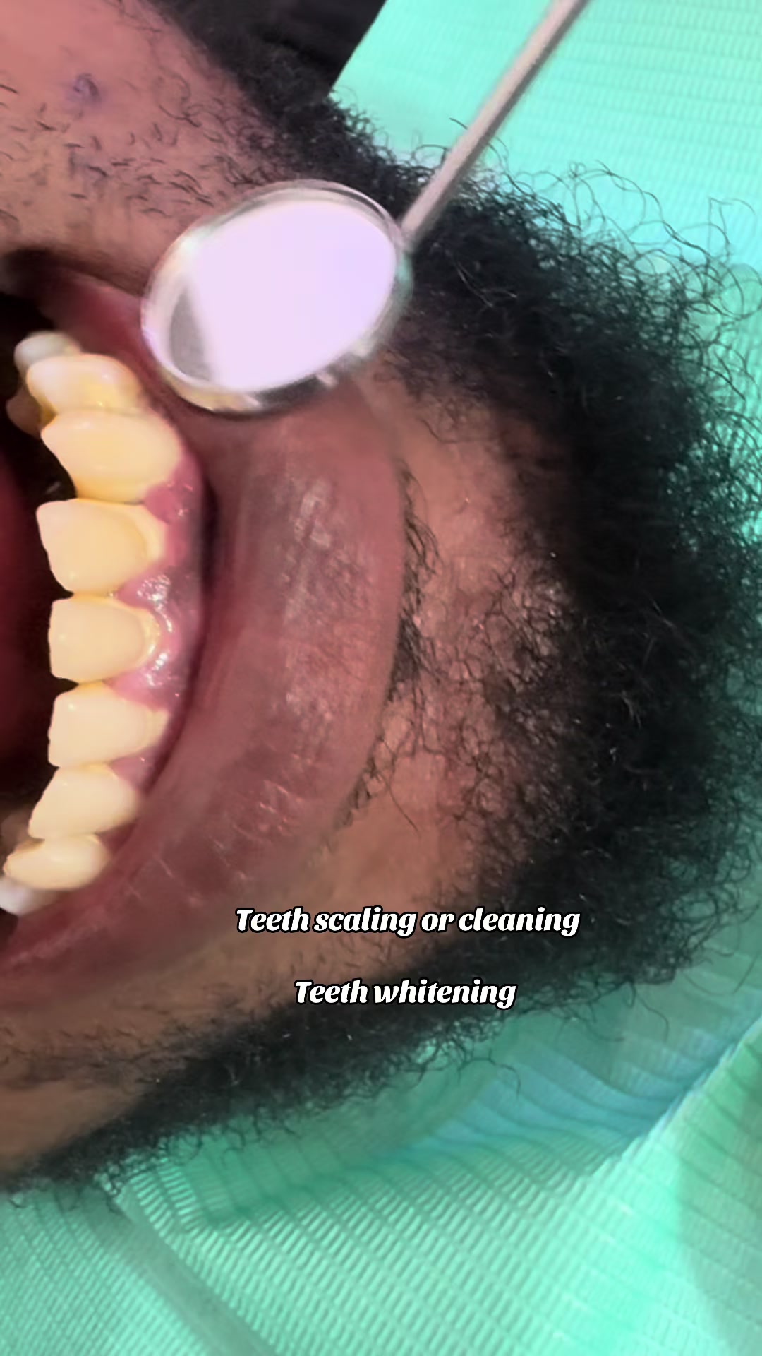 @Teethwhitening—MartGlow Avenue