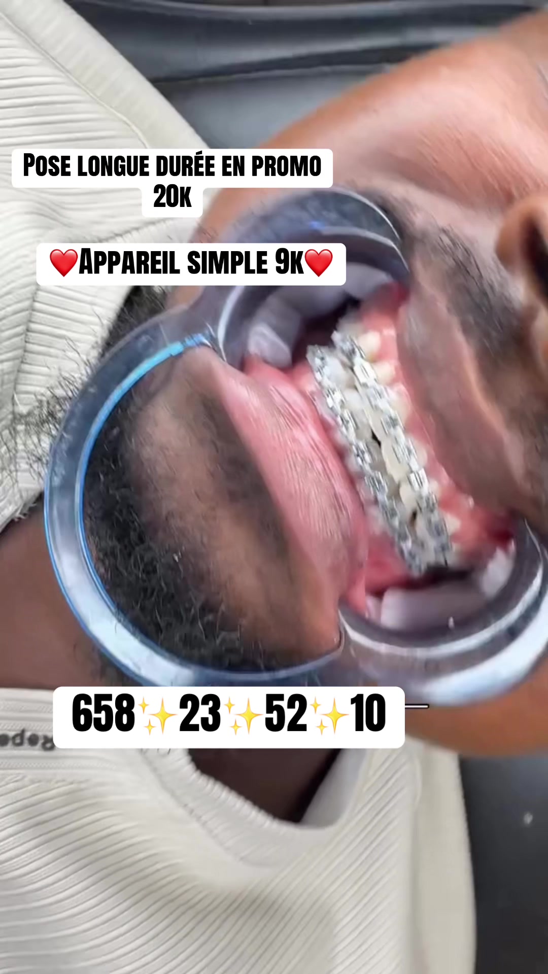 @MG BRACES