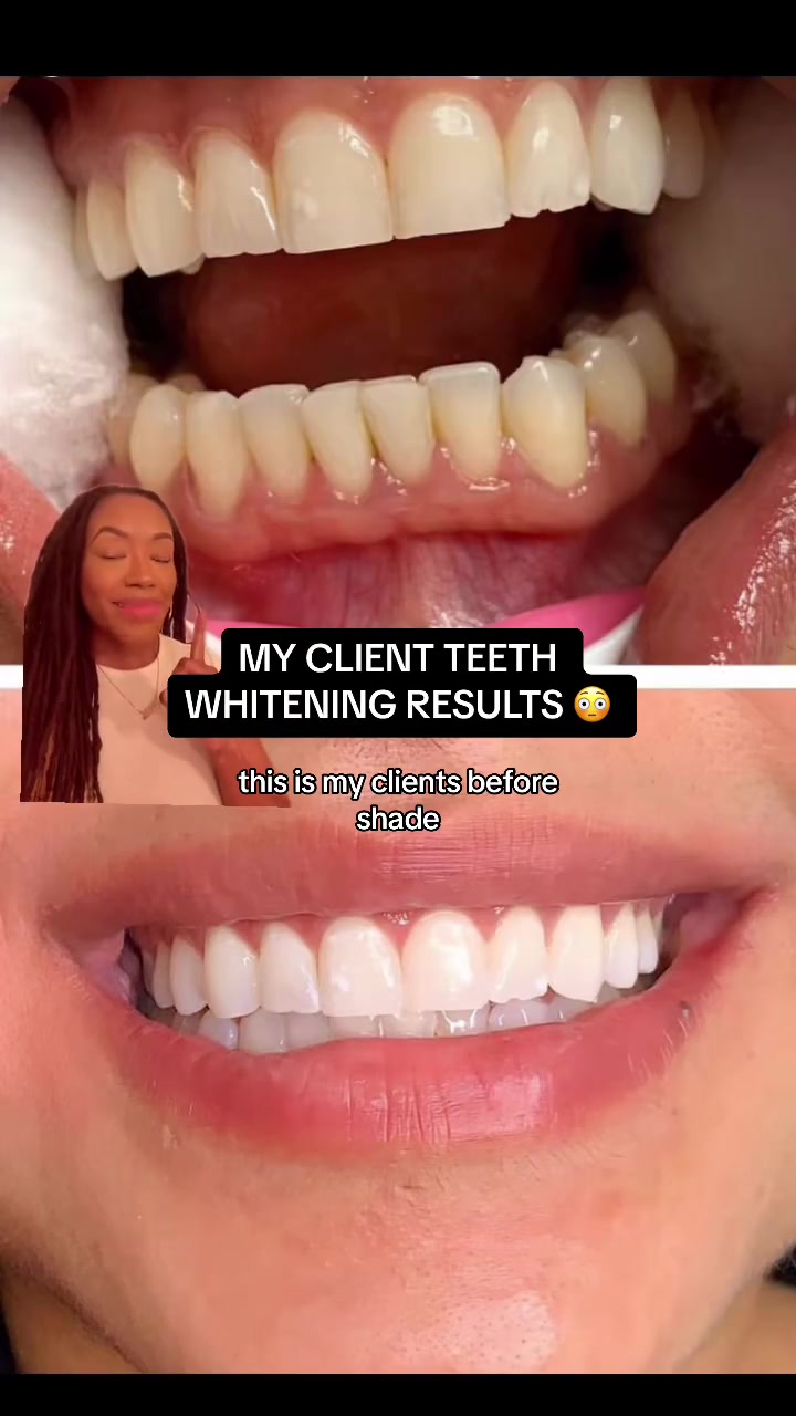@Diandra | Teeth Whitening Tech