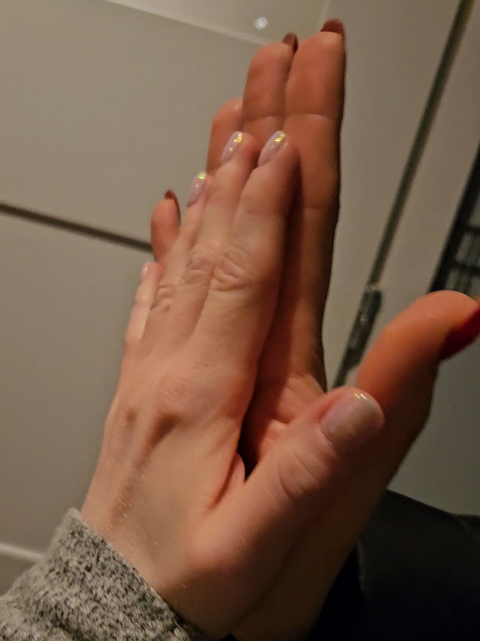 @vitiligo.girl