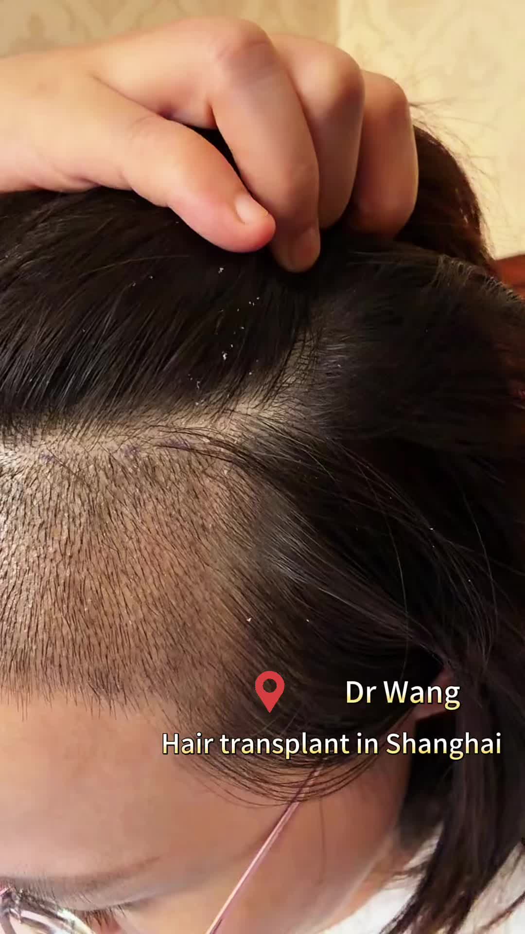 @HAIR TRANSPLANT WANG🇨🇳