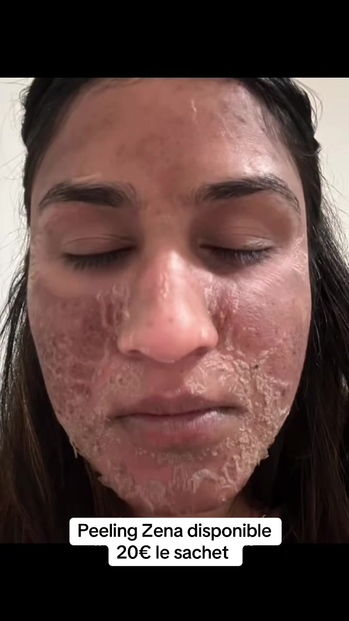 @peeling_zena