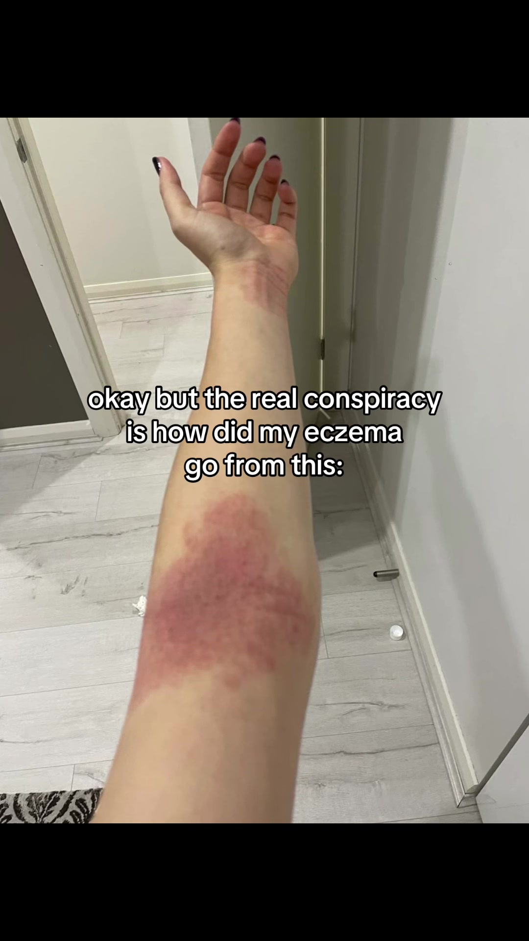 @Eczema Diaries USA & UK