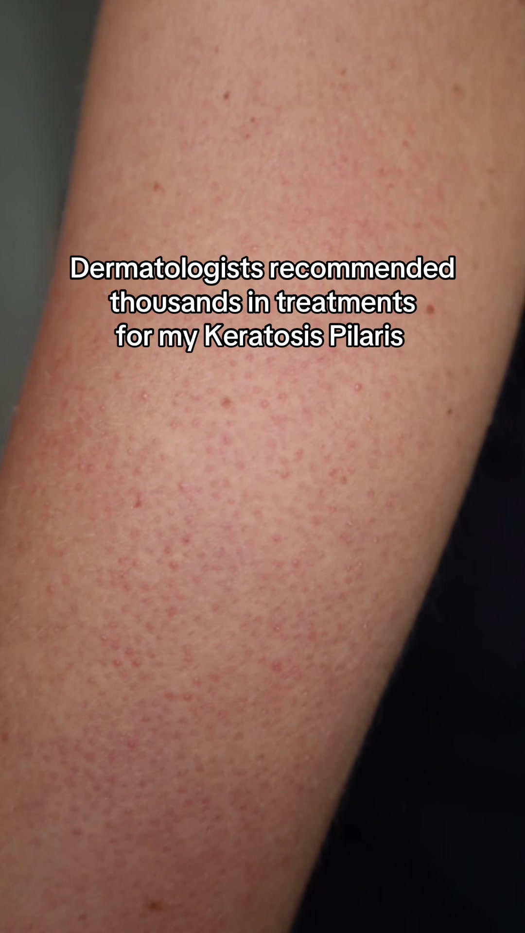 @Eczema Diaries USA & UK