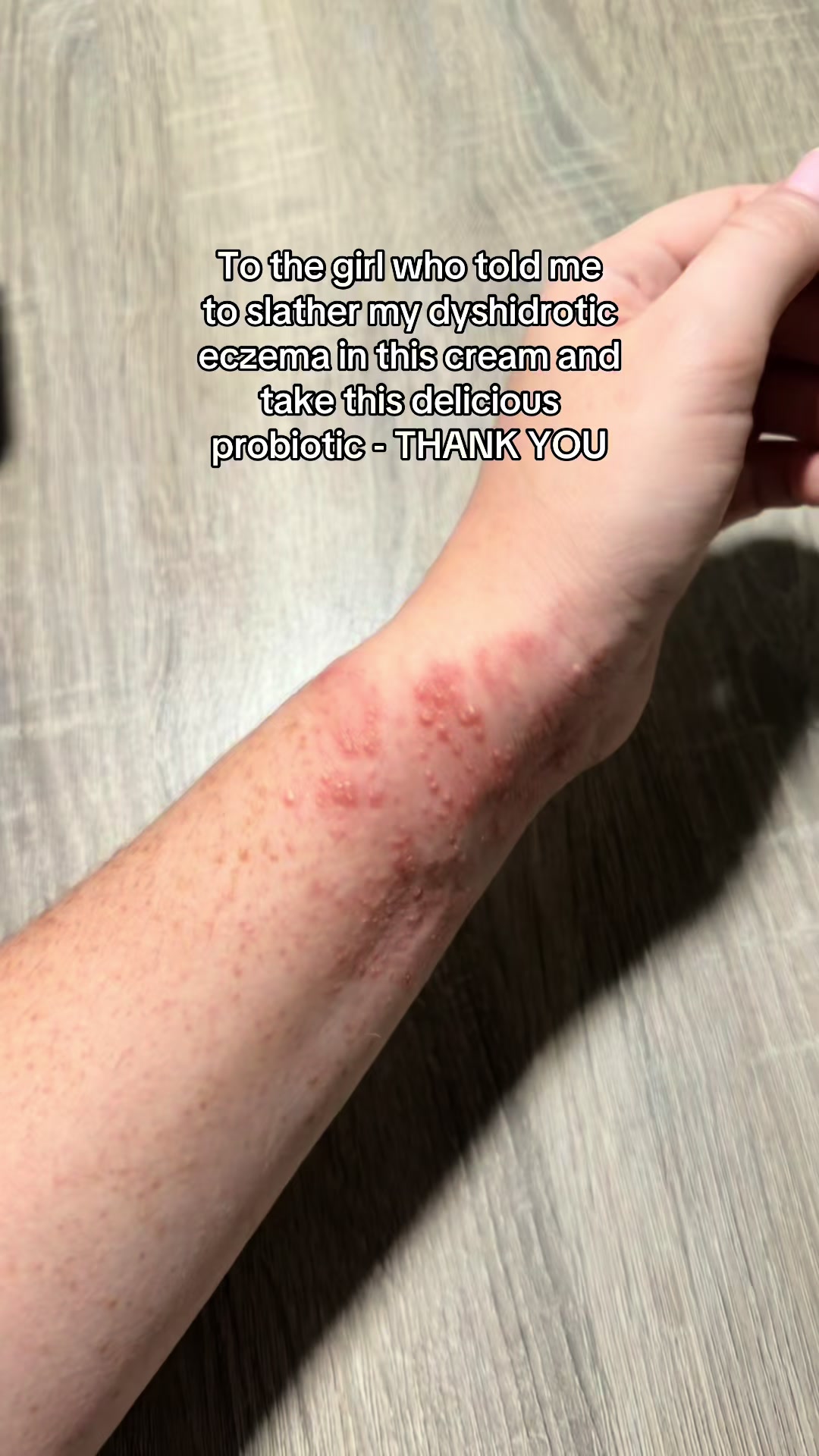 @Eczema Diaries USA & UK
