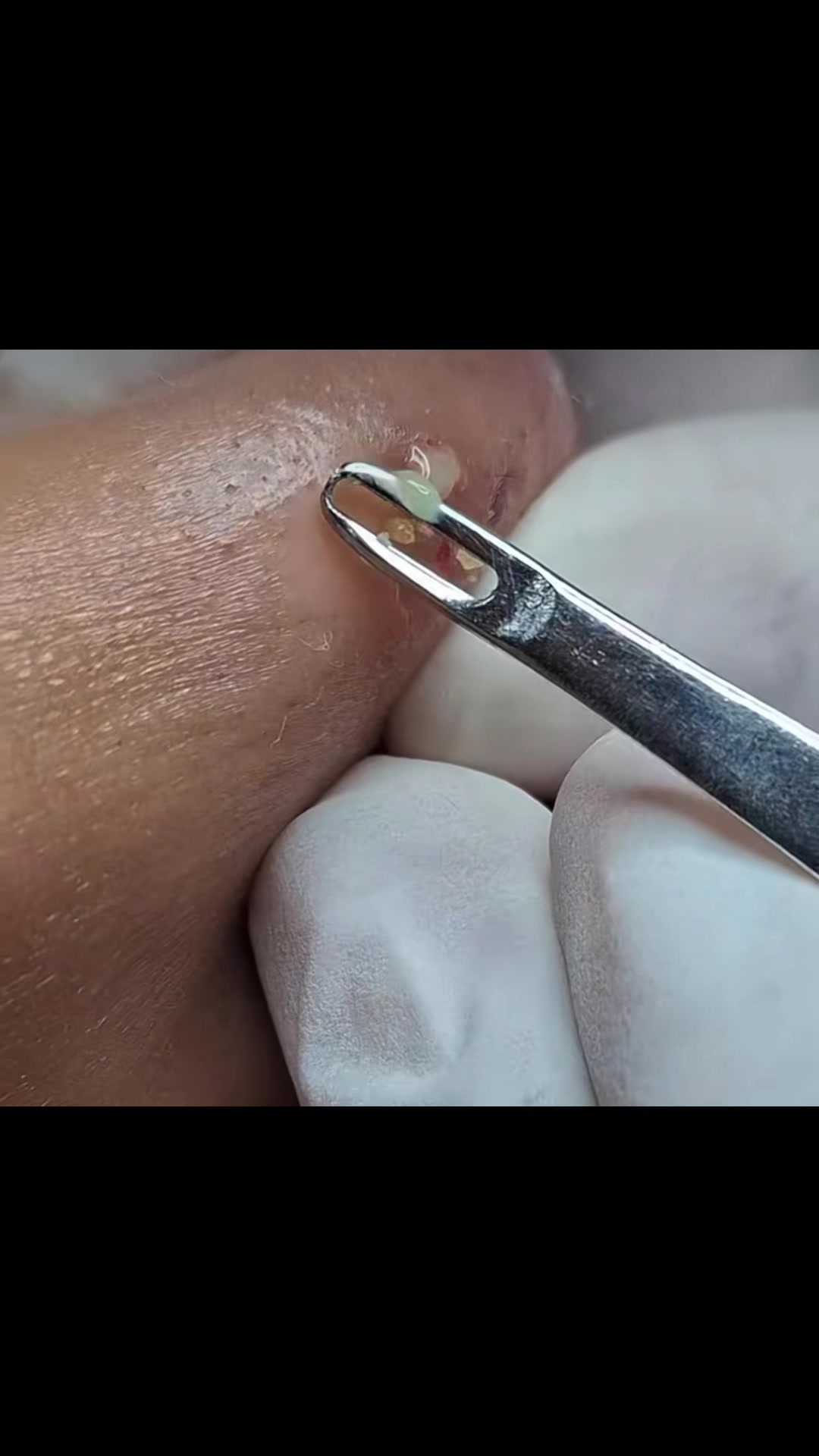 @pimplepopperasmr