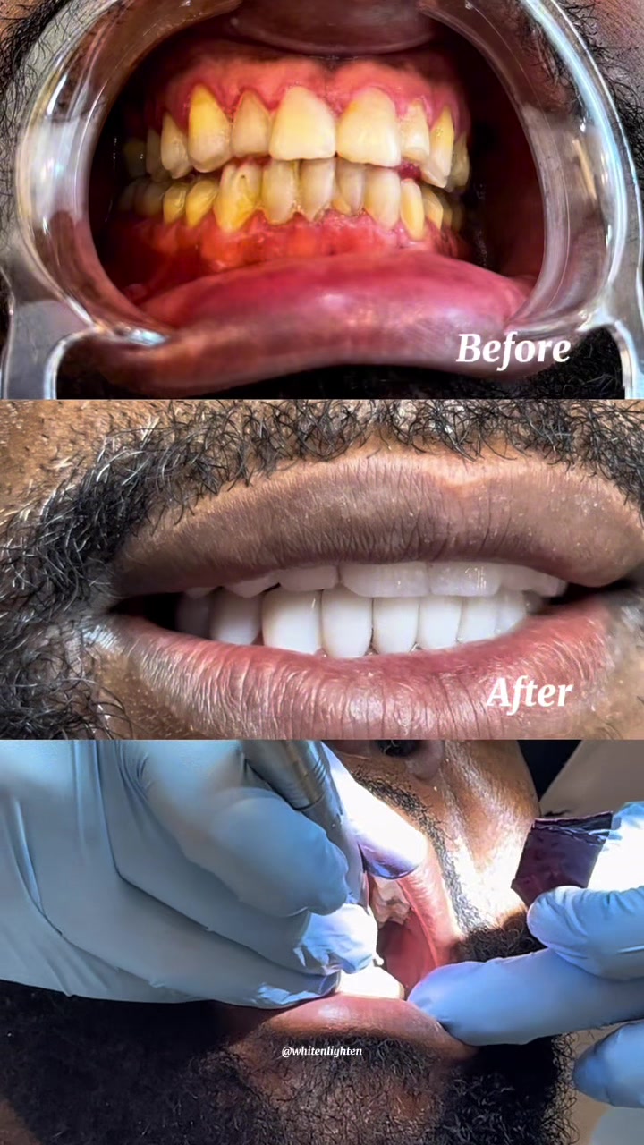 @Whiten Lighten TAC