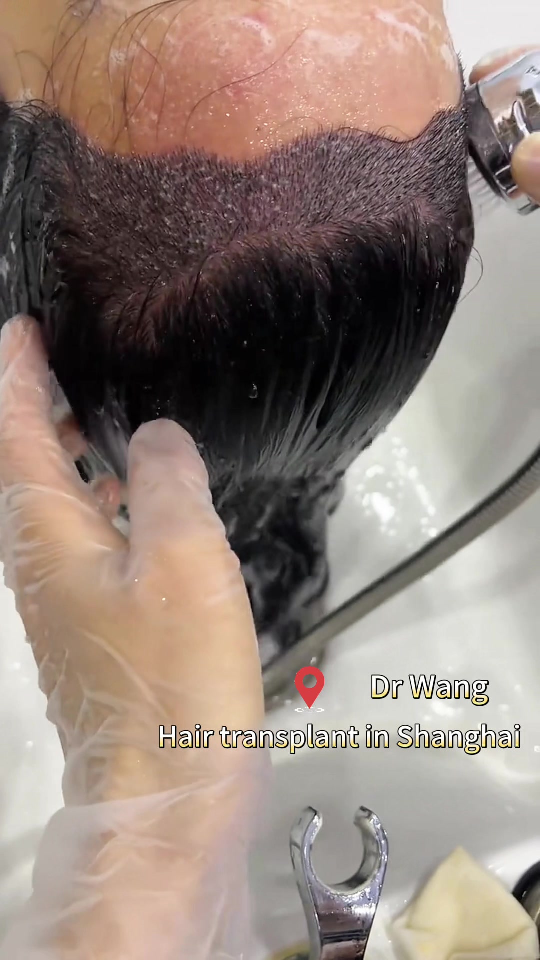 @HAIR TRANSPLANT WANG🇨🇳