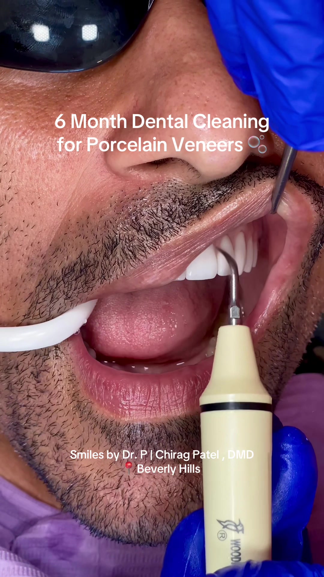 @Veneers