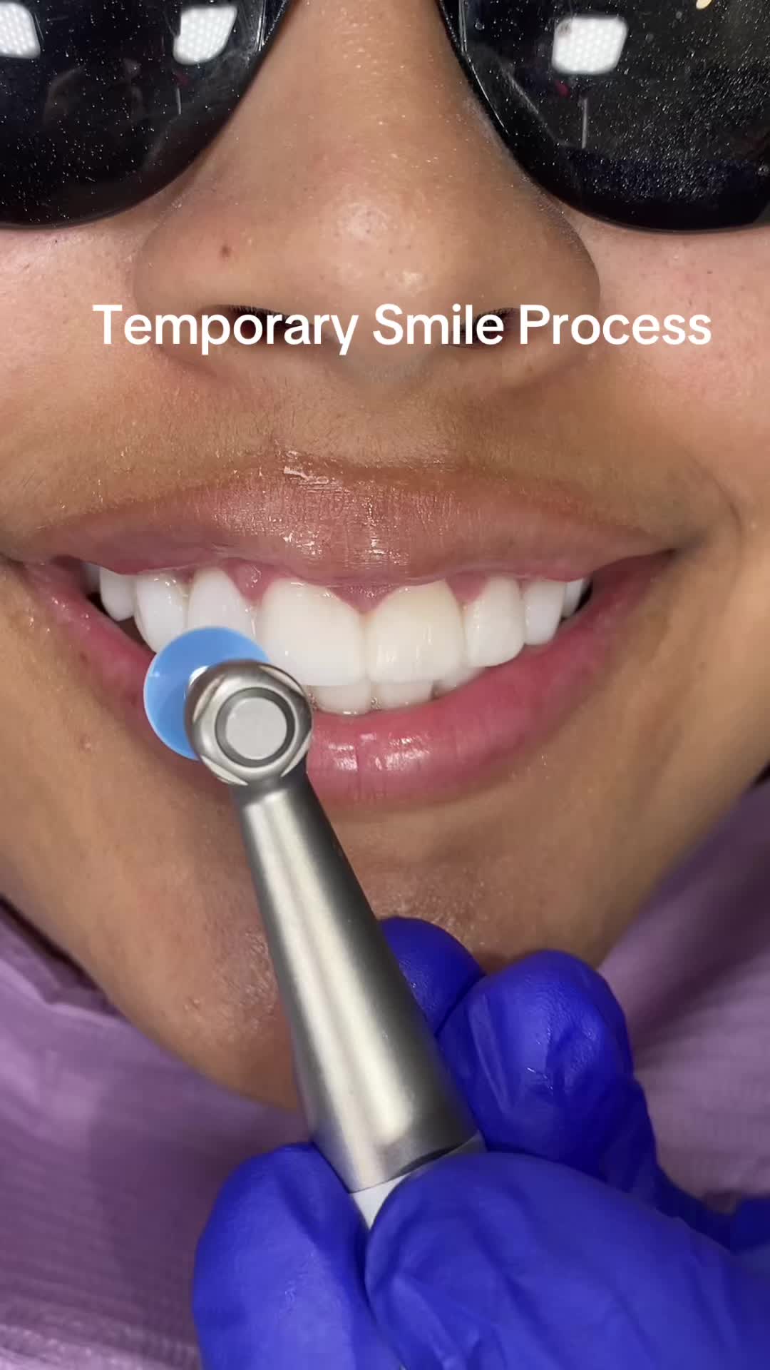 @Veneers