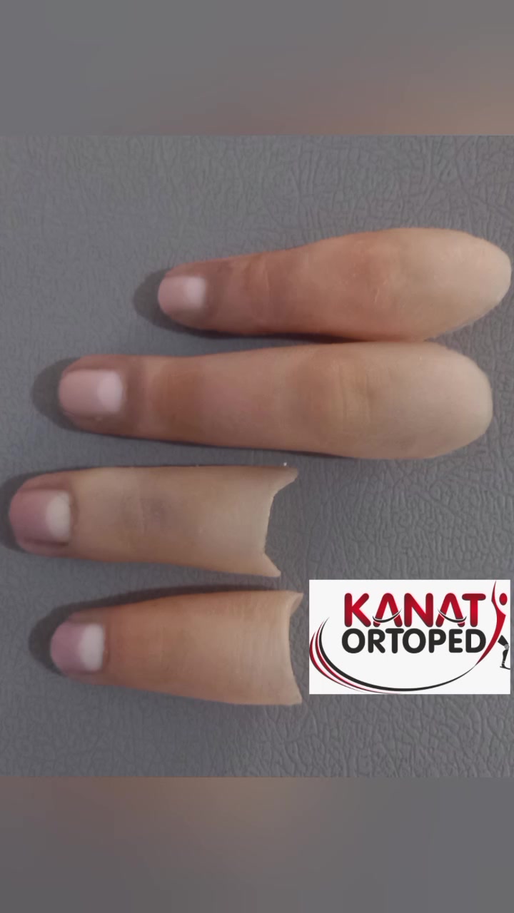 @KanatOrtopedi