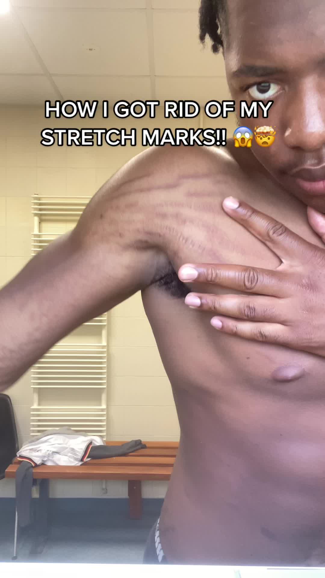 @Stretch marks guy