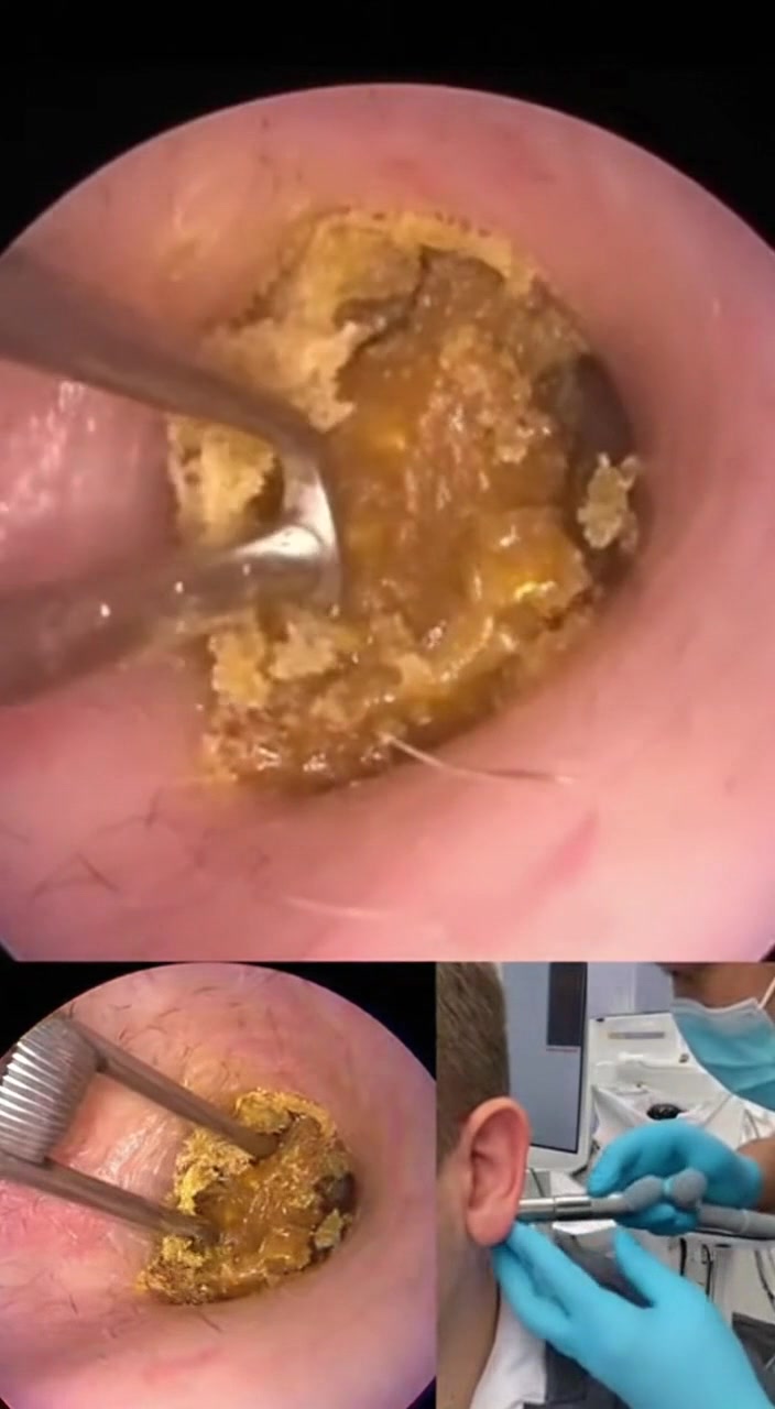 @Ear Cleaning